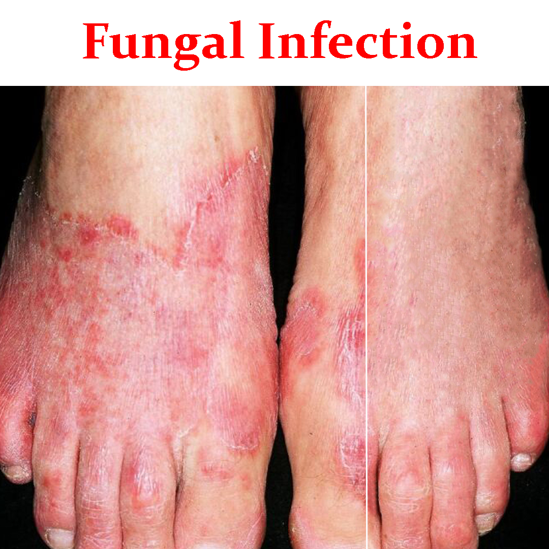 fungal-infections-types-causes-risk-factors-symptoms-diagnosis