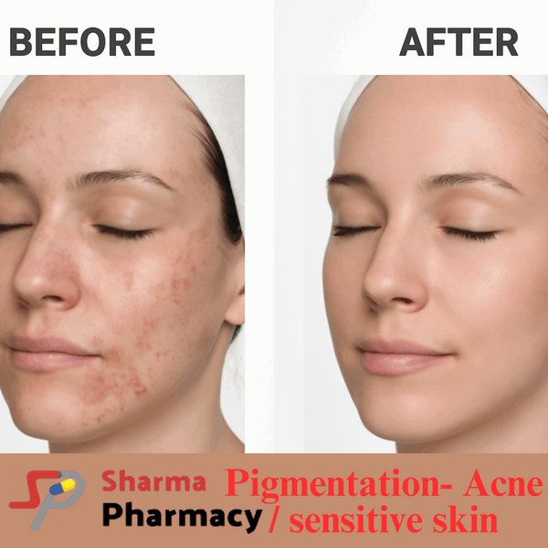 Pigmentation- Acne / sensitive skin Product Box