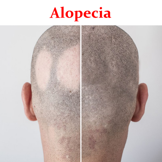 Aloepecia Maintenance Treatment
