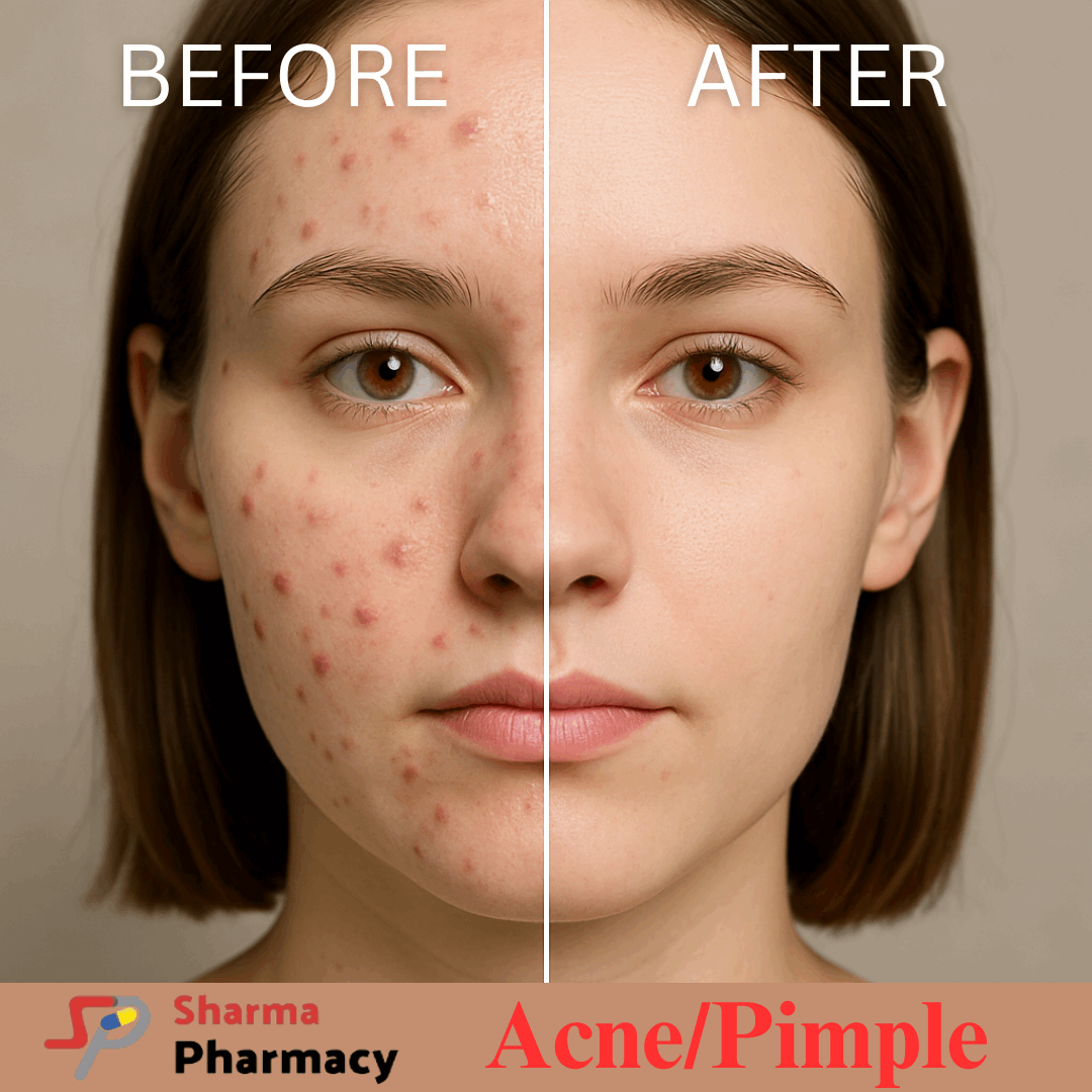 Pimples/Acne- Product Box