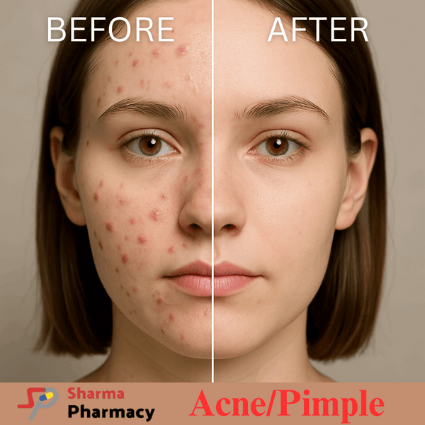 Pimples/Acne- Product Box