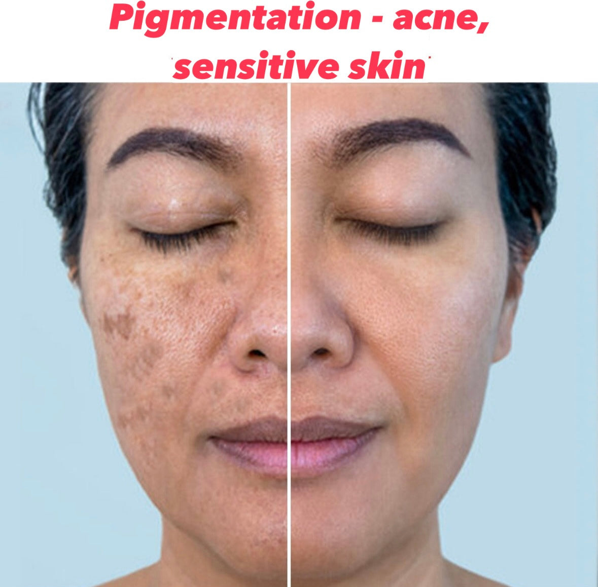 Pigmentation- Acne / sensitive skin Product Box