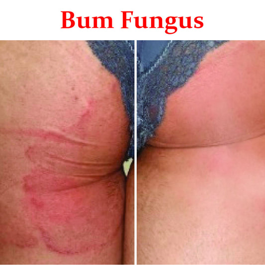 Bum Fungus- Product Box
