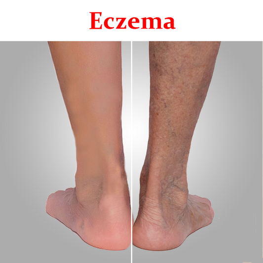 Eczema- Product Box