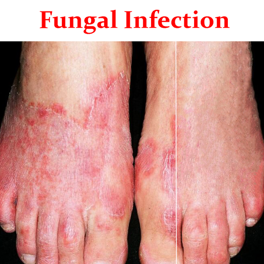 Fungal infection- Product Box
