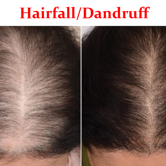 Hairfall/ dandruff- Product Box