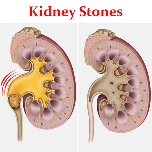 Kidney Stones- Product Box