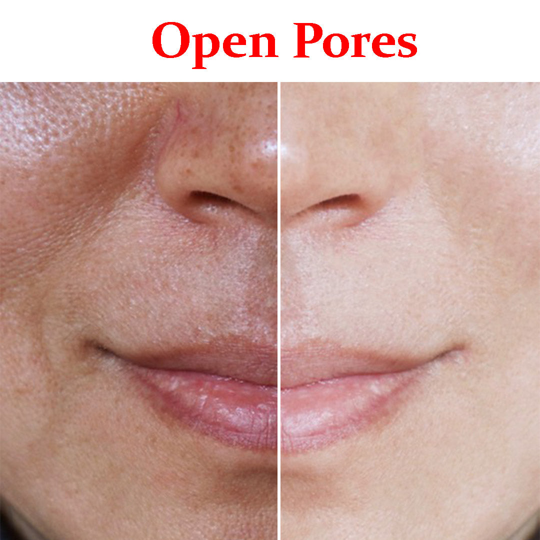 open pores