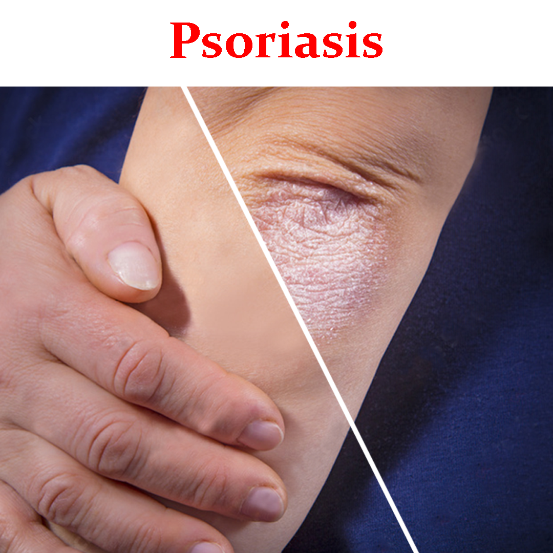 Psoriasis- Product Box