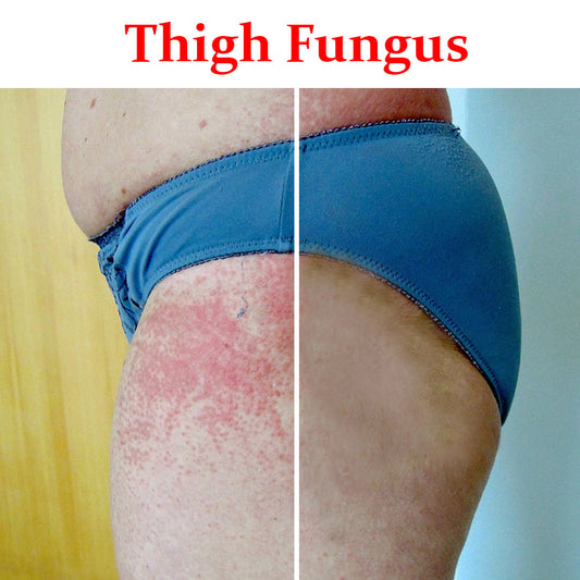 Thigh Fungus- Product Box