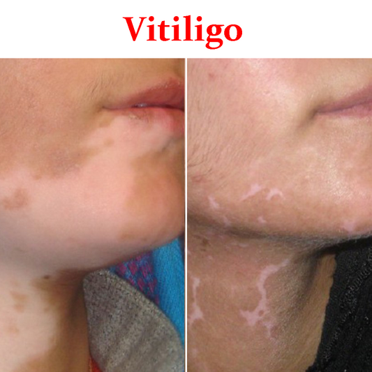 Vitiligo- Product Box