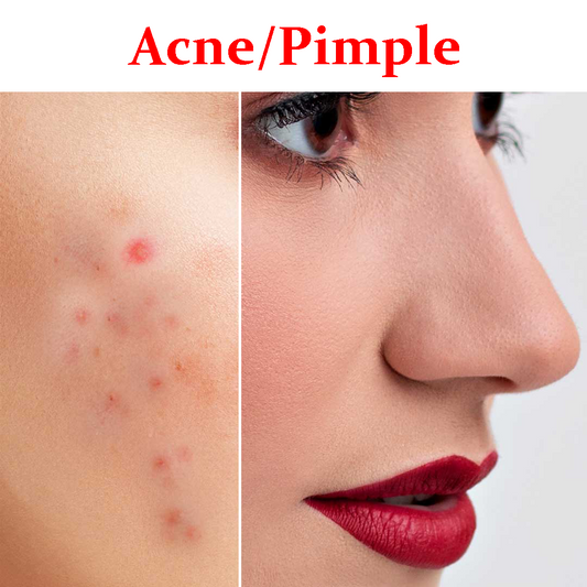 Pimples/Acne- Product Box
